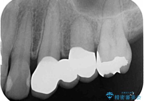 小矯正を伴う臼歯部ブリッジ治療の治療後