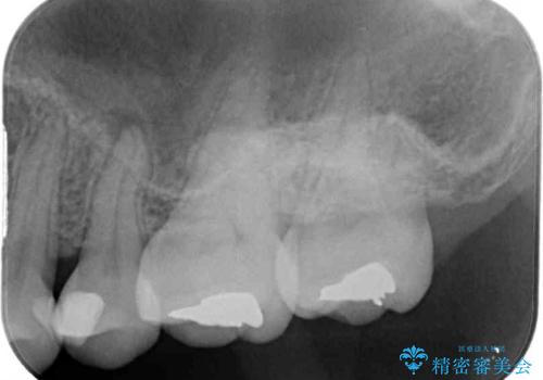 奥歯が痛い　保険治療後に症状が発現した歯のむし歯治療の治療前