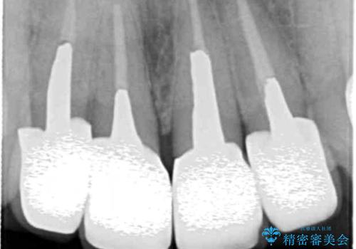 老朽化した前歯のクラウンやりかえの治療後