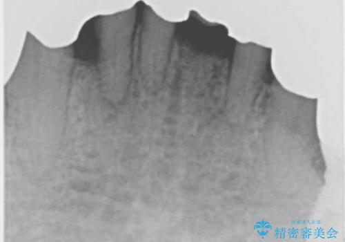 他院で抜歯と言われた歯 歯も神経も残したい 50代男性の治療後