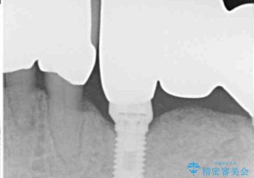 他院で抜歯と言われた歯 歯も神経も残したい 50代男性の治療後