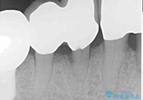 歯がぐらぐら 再生療法で抜かずに残す 50代男性の治療後