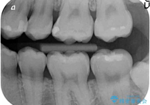 奥歯の虫歯 歯の間を広げてセラミックでしっかり治療の治療後