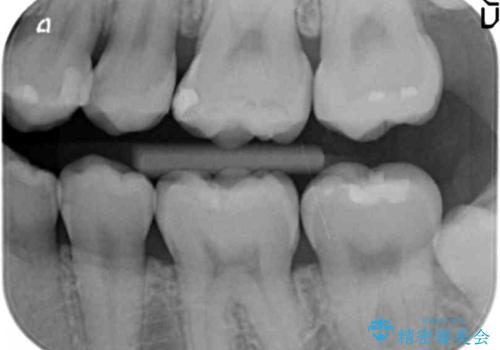 奥歯の虫歯　歯の間を広げてセラミックでしっかり治療の治療後
