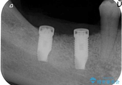 歯がないまま放置していた 奥歯のインプラント 50代男性の治療中