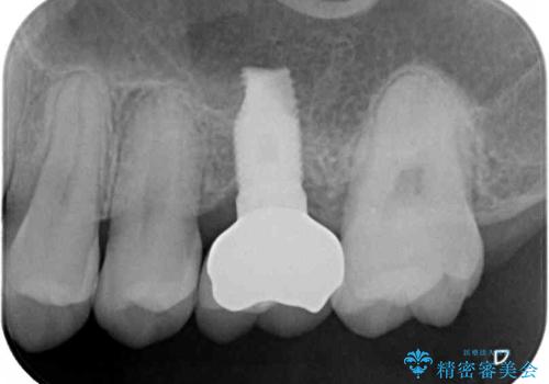 前歯のクロスバイトと抜歯が必要な奥歯の虫歯 インビザラインとインプラント治療の治療後
