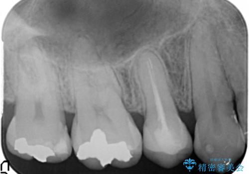 低予算で銀歯を白くしたい 50代女性の治療後