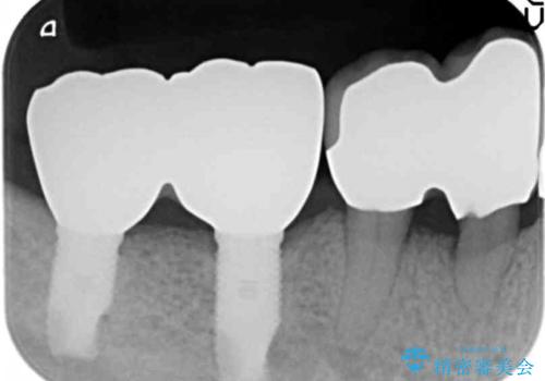 歯がないまま放置していた　奥歯のインプラント　50代男性の治療後