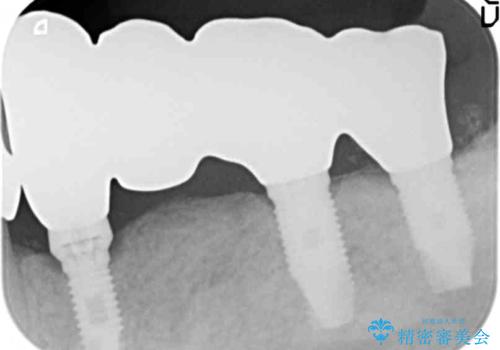 歯がぐらぐらで咬めない 奥歯のインプラント 50代男性の治療後