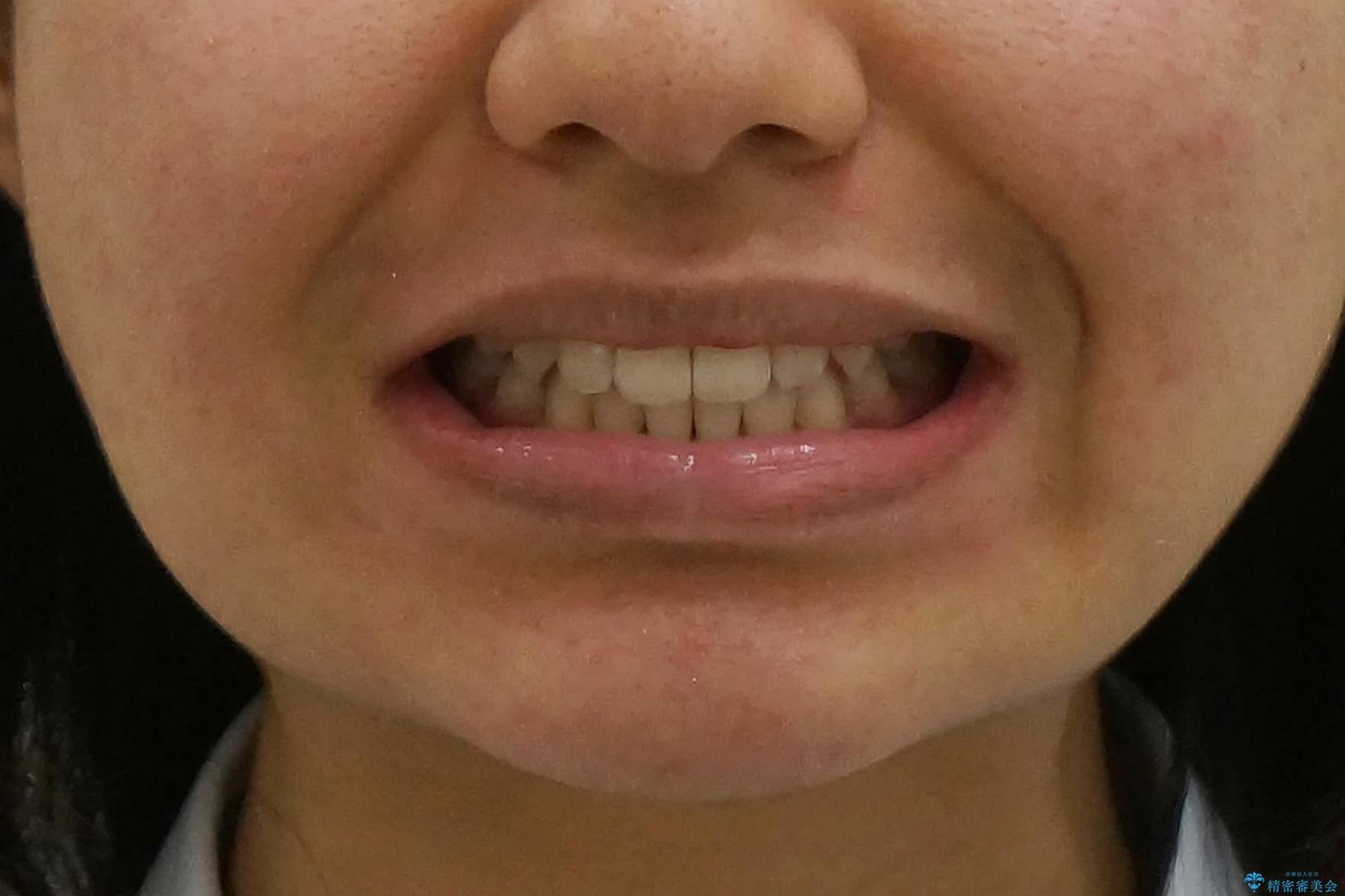 インビザラインチェンジで成功 インビザラインで八重歯の抜歯矯正の治療後(顔貌)