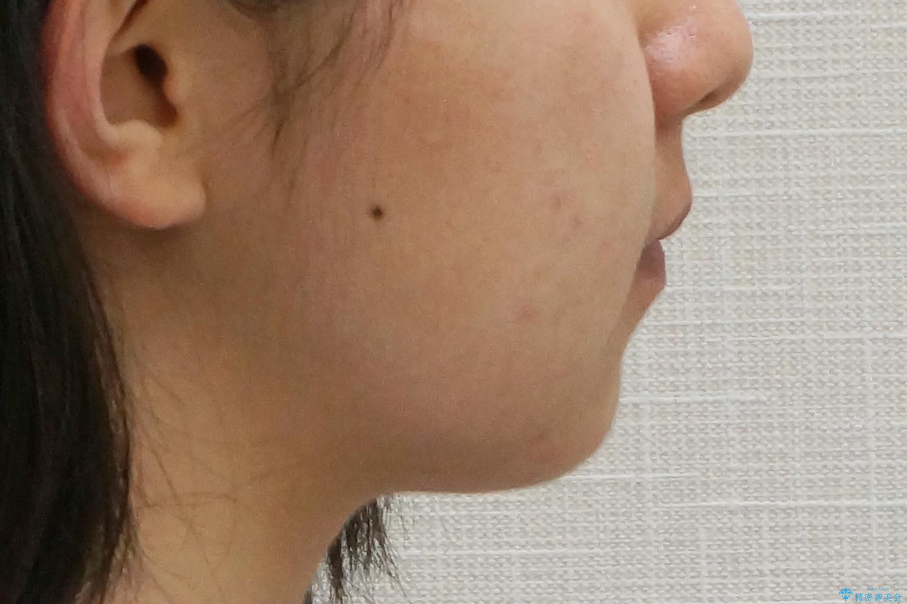 インビザラインチェンジで成功 インビザラインで八重歯の抜歯矯正の治療後(顔貌)