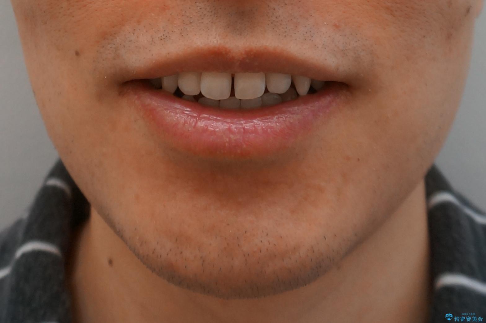 前歯のすき間 セラミックで綺麗に 最短で治療の治療前(顔貌)