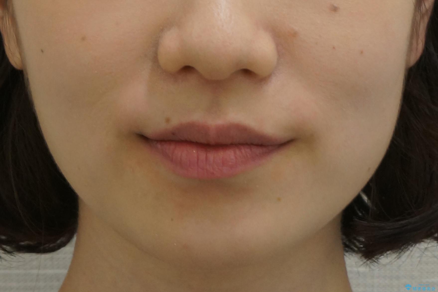 前歯が気になる 大人のマウスピース矯正 矮小歯を整えるの治療後(顔貌)