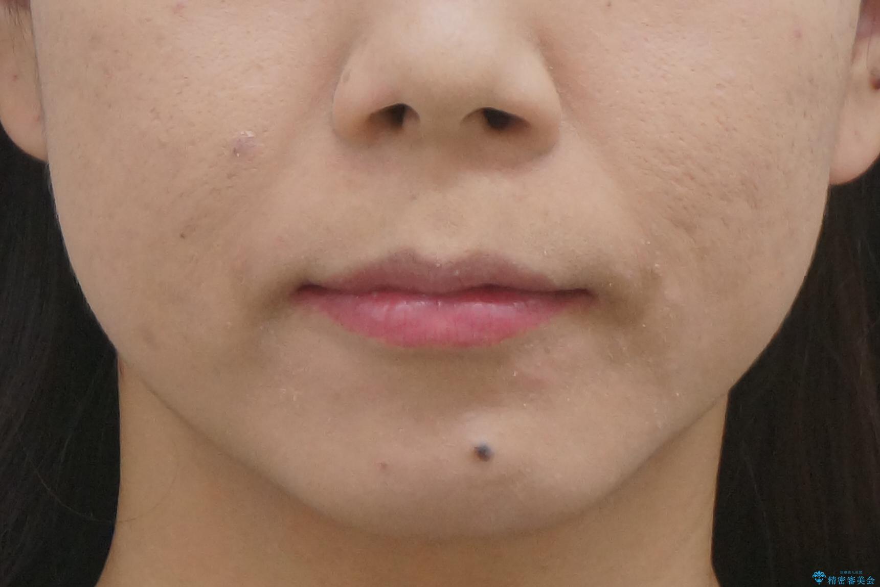 出っ歯 下の歯のガタガタ 下の前歯のみ1本抜歯 マウスピースで1年の治療後(顔貌)