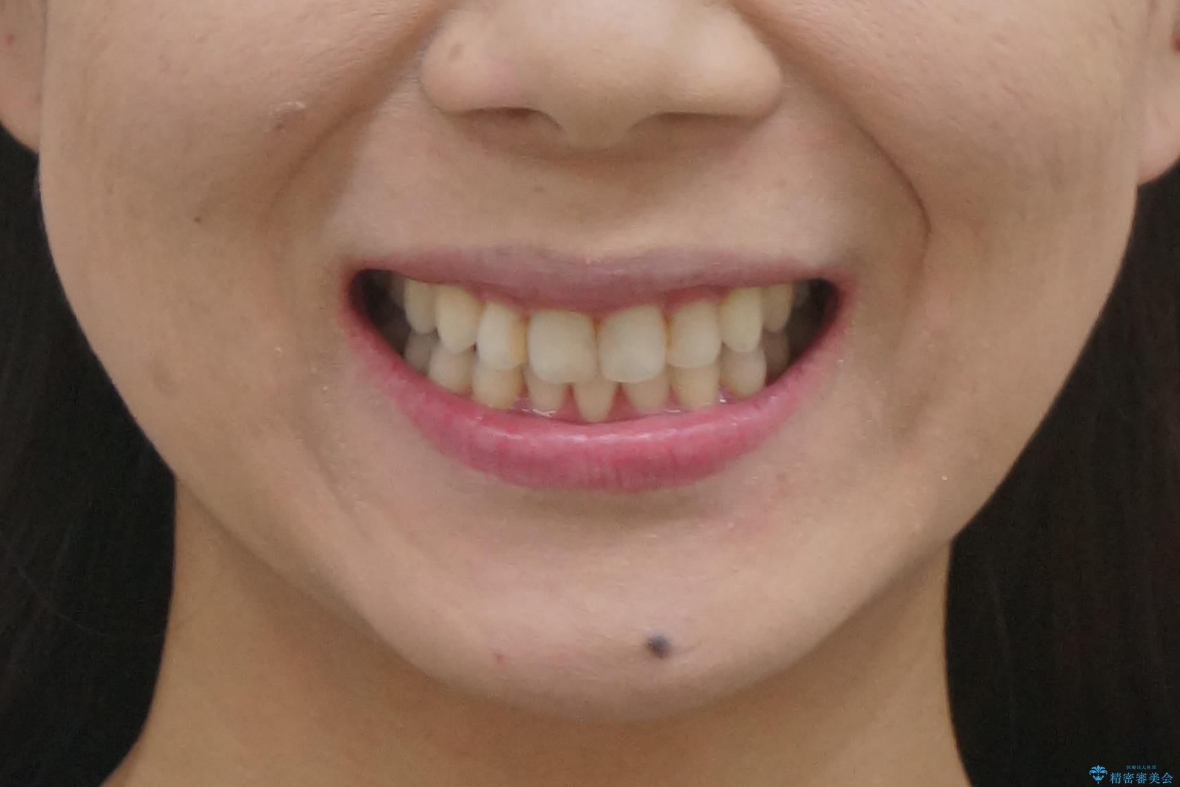 出っ歯 下の歯のガタガタ 下の前歯のみ1本抜歯 マウスピースで1年の治療後(顔貌)