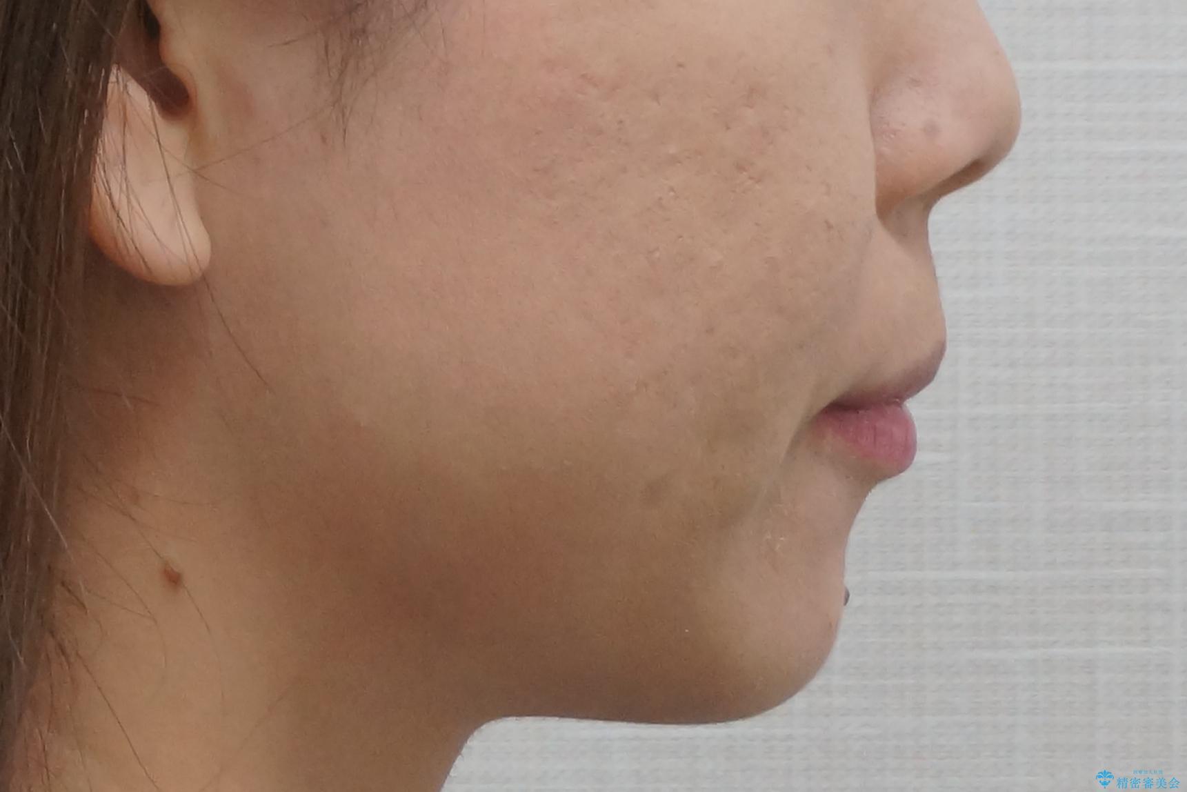 出っ歯 下の歯のガタガタ 下の前歯のみ1本抜歯 マウスピースで1年の治療後(顔貌)