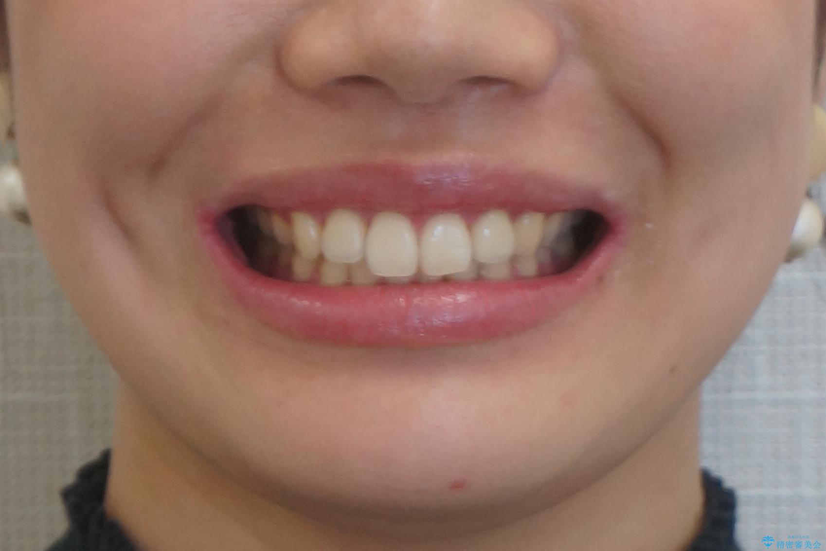 下の前歯が1本短い インビザラインと部分矯正の組み合わせの治療後(顔貌)