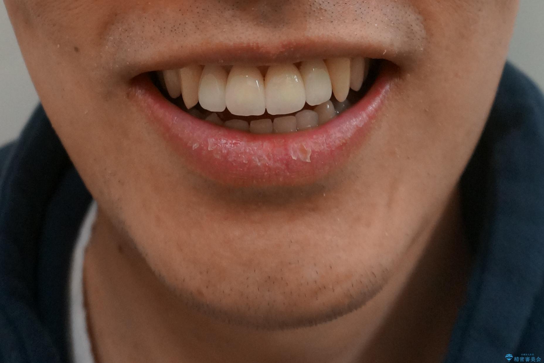 前歯のすき間 セラミックで綺麗に 最短で治療の治療後(顔貌)