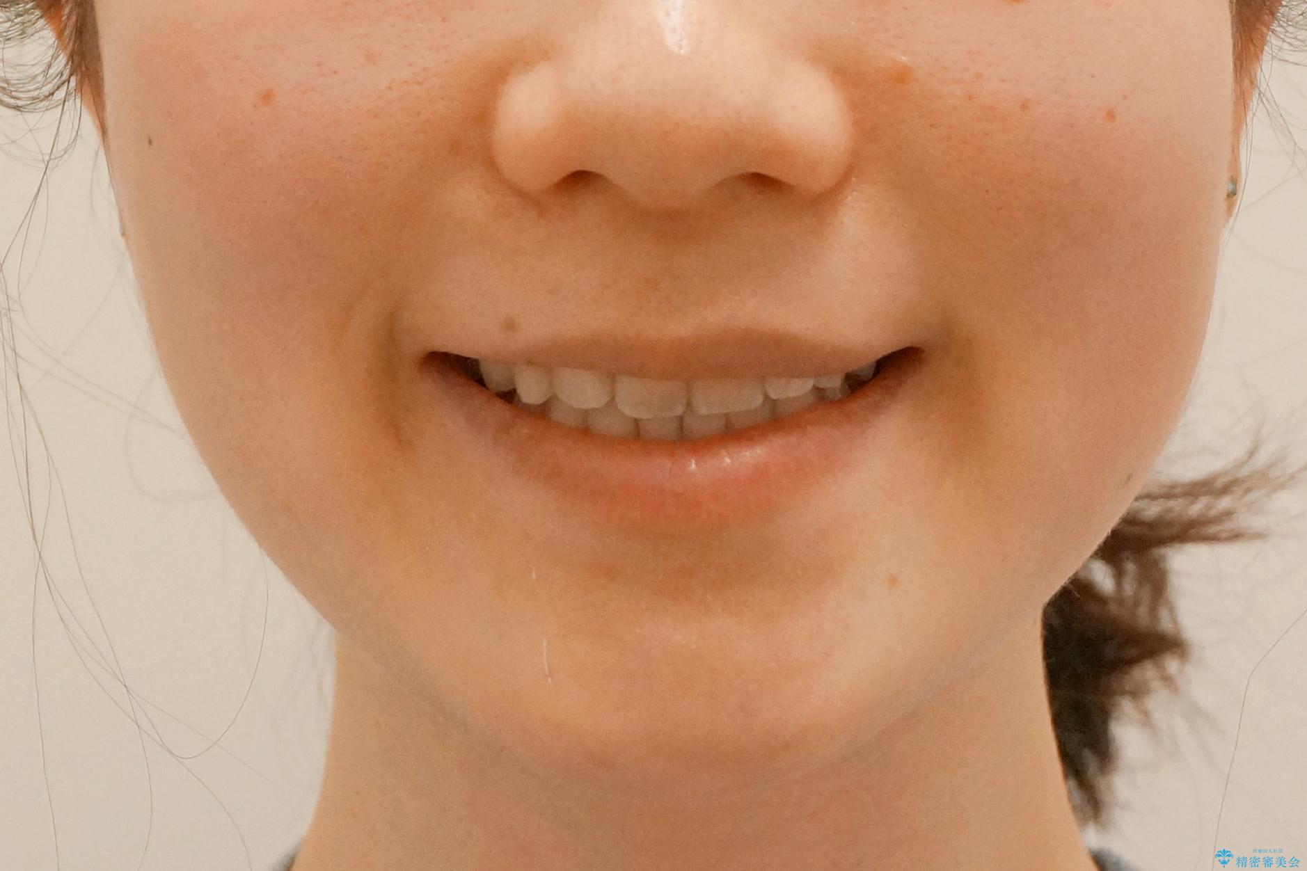 前歯が気になる 大人のマウスピース矯正 矮小歯を整えるの治療後(顔貌)