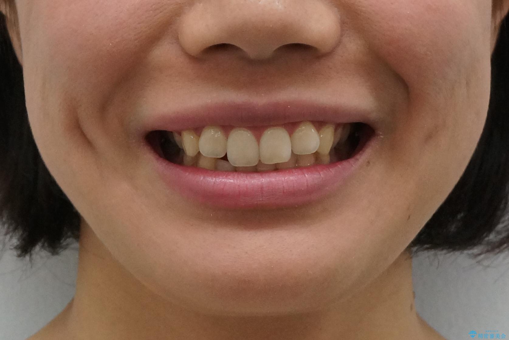 下の前歯が1本短い インビザラインと部分矯正の組み合わせの治療前(顔貌)