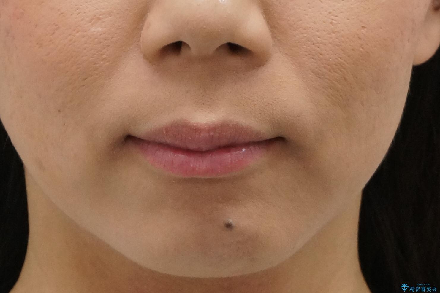 出っ歯 下の歯のガタガタ 下の前歯のみ1本抜歯 マウスピースで1年の治療前(顔貌)