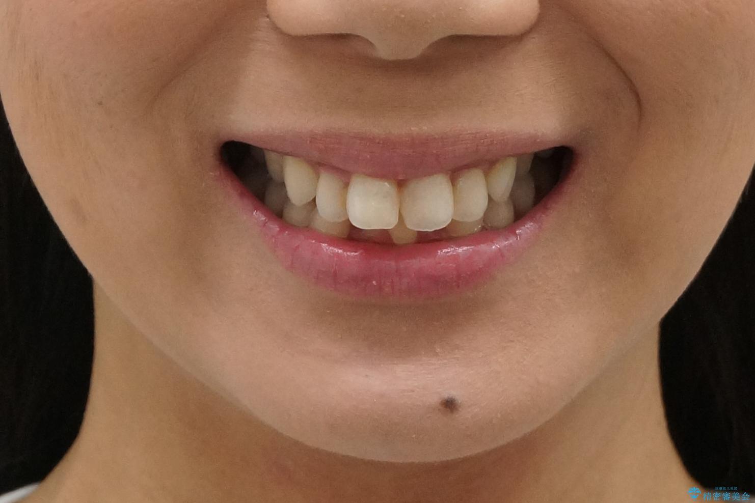 出っ歯 下の歯のガタガタ 下の前歯のみ1本抜歯 マウスピースで1年の治療前(顔貌)