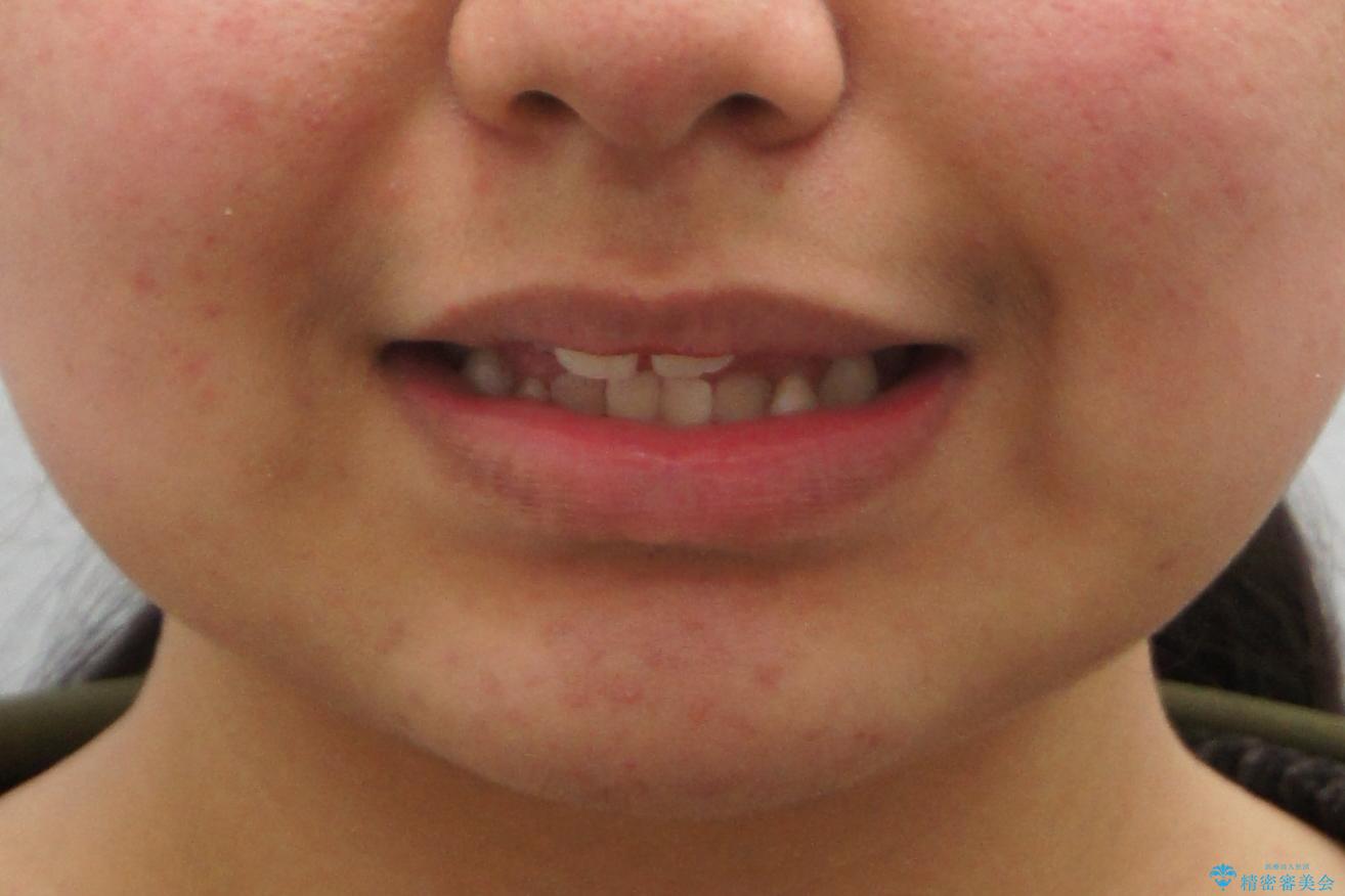 インビザラインチェンジで成功 インビザラインで八重歯の抜歯矯正の治療前(顔貌)