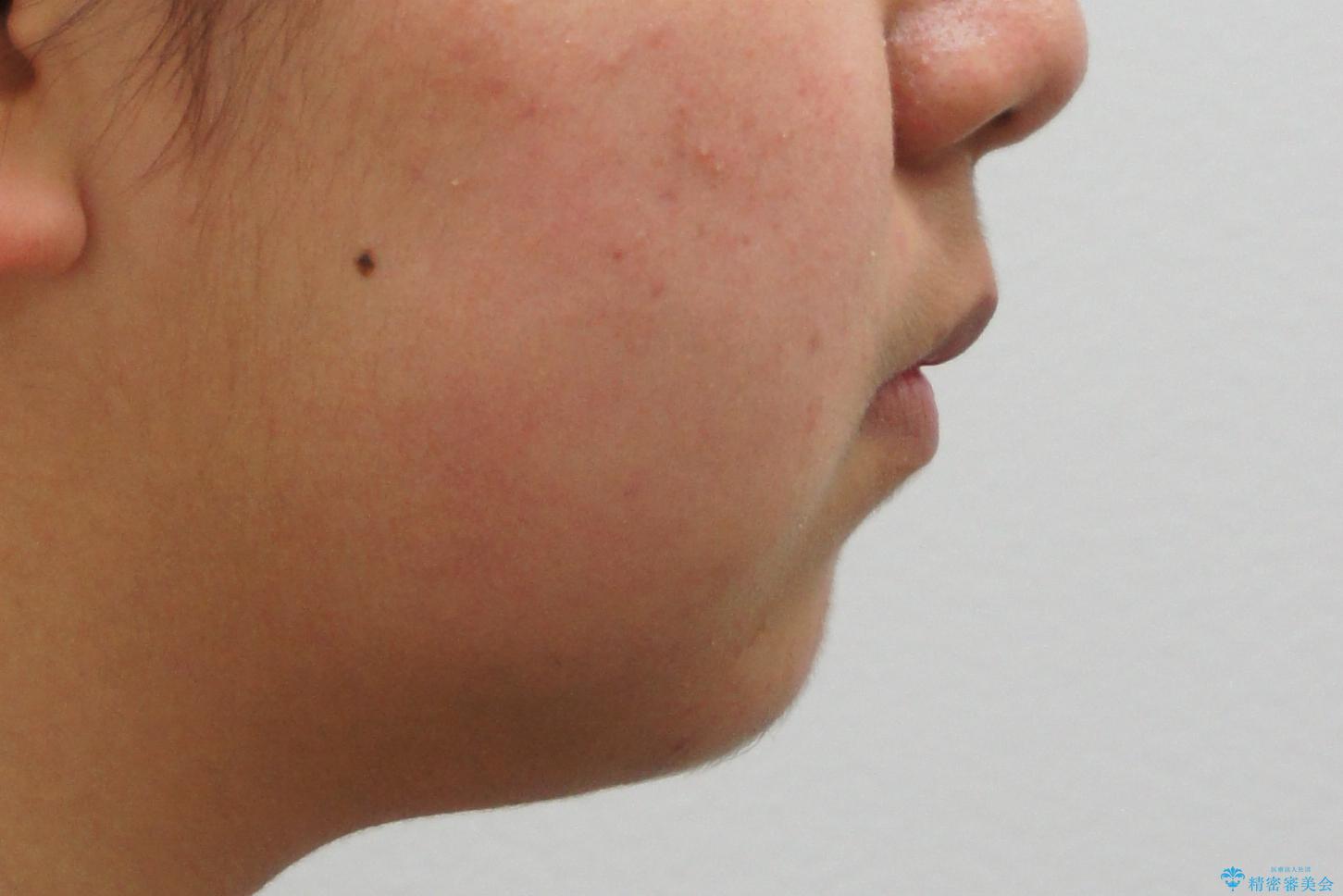 インビザラインチェンジで成功 インビザラインで八重歯の抜歯矯正の治療前(顔貌)