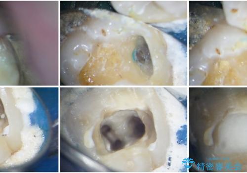 奥歯が痛い 保険治療後に症状が発現した歯のむし歯治療の治療中