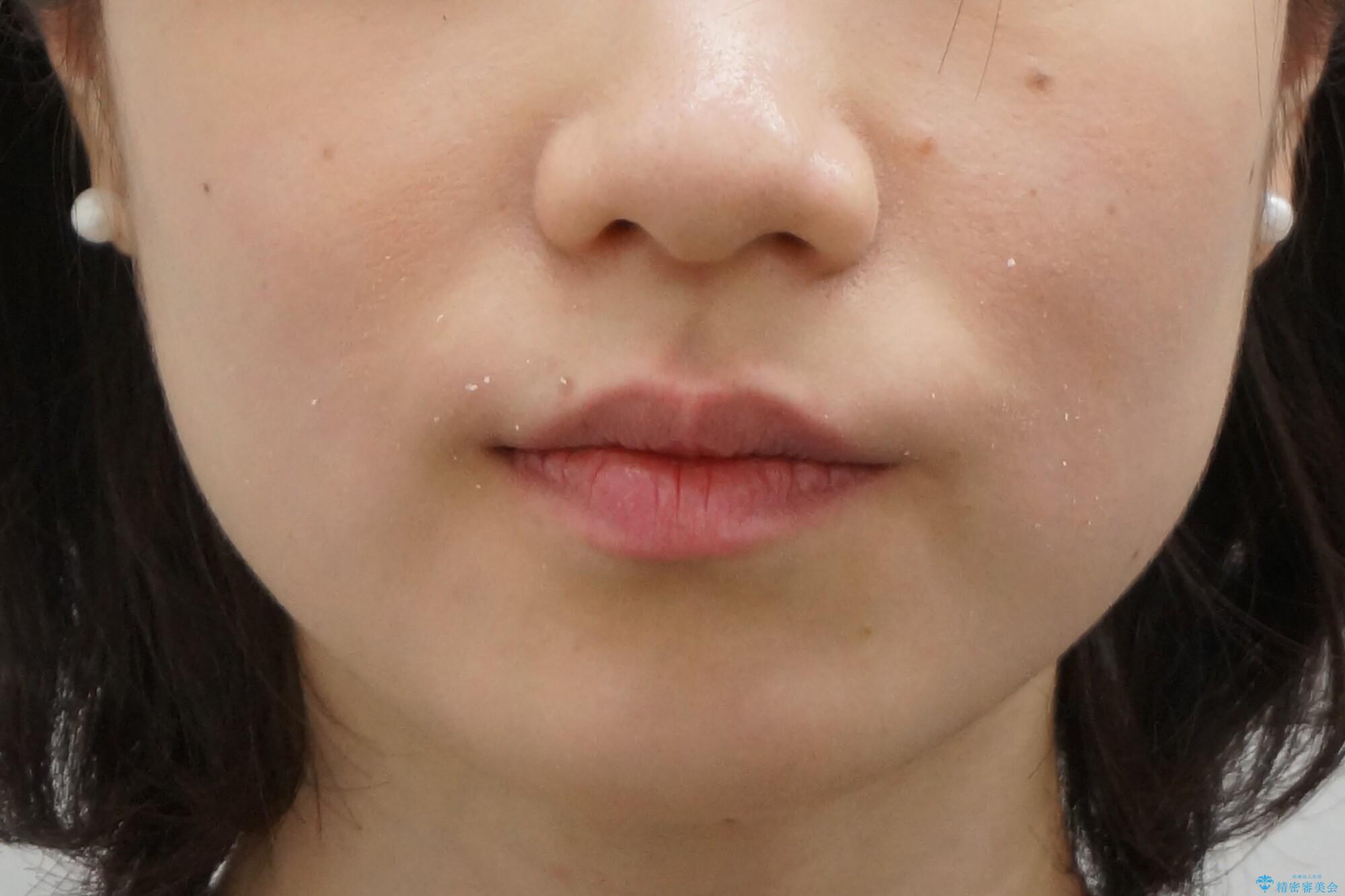 前歯が気になる 大人のマウスピース矯正 矮小歯を整えるの治療前(顔貌)