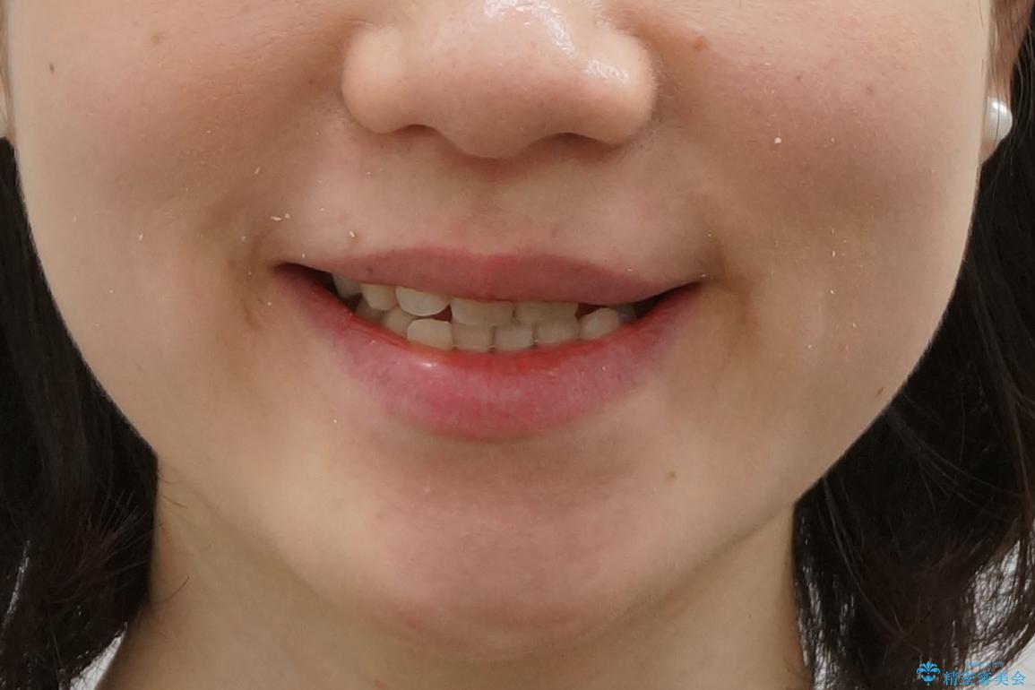 前歯が気になる 大人のマウスピース矯正 矮小歯を整えるの治療前(顔貌)