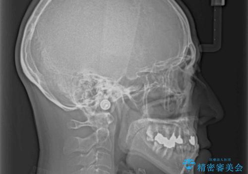 下の歯が前に出てしまう咬み合わせを治したい インビザラインによる矯正治療の治療前