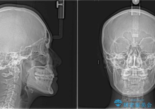 急速拡大装置で奥歯の咬み合わせを改善 インビザラインによる矯正治療の治療後