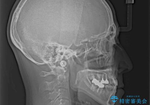 下の歯が前に出てしまう咬み合わせを治したい インビザラインによる矯正治療の治療後