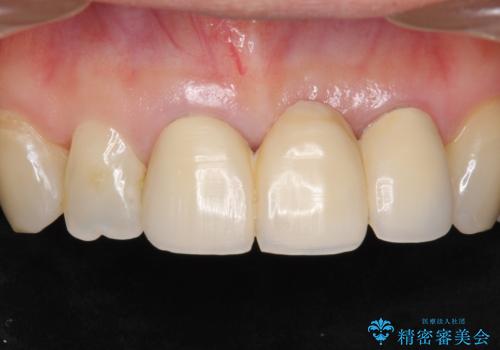 不自然なブリッジ 自然なセラミックでやりかえ 30代女性の治療前
