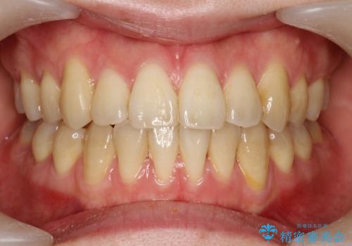 プラークなどによる歯の黄ばみの治療前