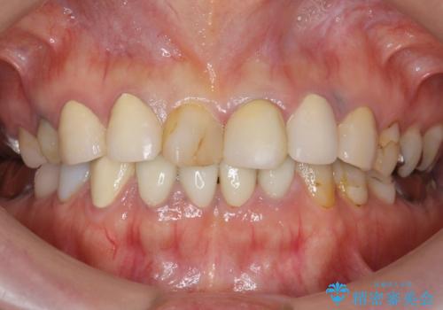 被せ物を入れたばかりの歯が痛む 40代女性の治療後