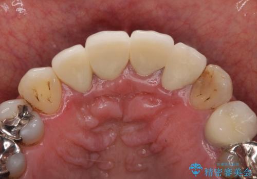 老朽化した前歯のクラウンやりかえの治療後