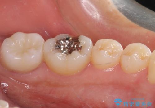奥歯が痛い　保険治療後に症状が発現した歯のむし歯治療の治療後