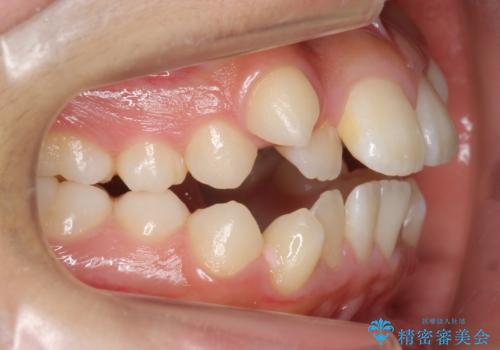 インビザラインチェンジで成功 インビザラインで八重歯の抜歯矯正の治療前