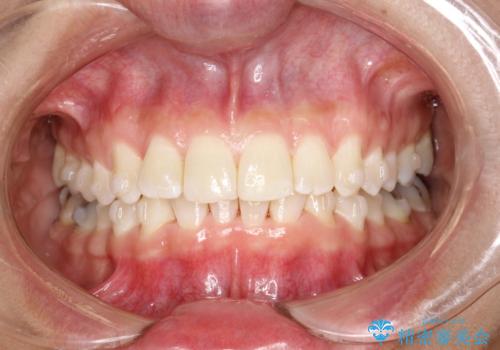 前歯のガタガタをインビザラインで矯正の治療中