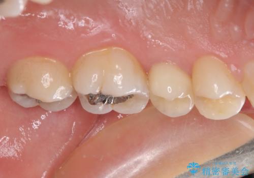 奥歯が痛い 保険治療後に症状が発現した歯のむし歯治療の治療後
