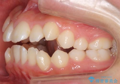 インビザラインチェンジで成功　インビザラインで八重歯の抜歯矯正の治療前