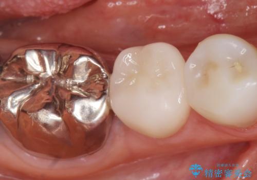 被せ物を入れたばかりの歯が痛む 40代女性の症例 治療後