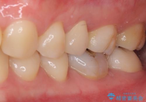 奥歯が痛い 保険治療後に症状が発現した歯のむし歯治療の治療後