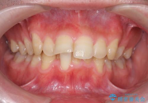 [ インビザライン ] マウスピース矯正で治す出っ歯の治療の症例 治療前
