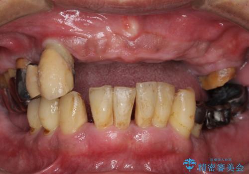 他院で抜歯と言われた歯 歯も神経も残したい 50代男性の治療前