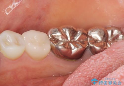 被せ物を入れたばかりの歯が痛む 40代女性の治療後
