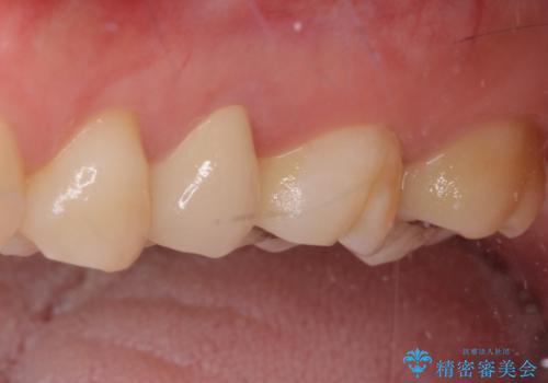奥歯が痛い 保険治療後に症状が発現した歯のむし歯治療の治療後