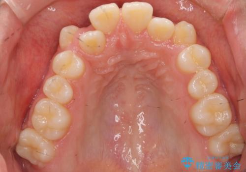 インビザラインチェンジで成功　インビザラインで八重歯の抜歯矯正の治療前